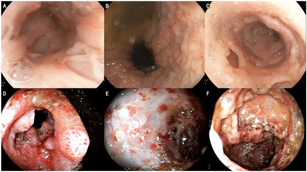 Enfermedad de Crohn 2 Enfermedad de Crohn