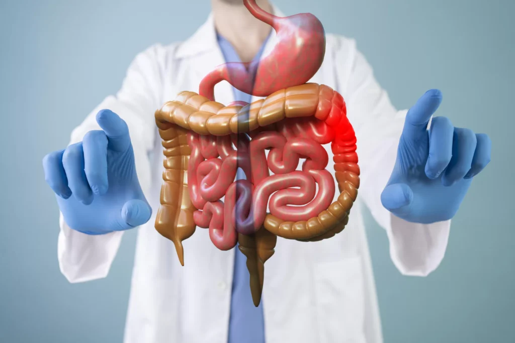 Enfermedad de Crohn 3 Enfermedad de Crohn