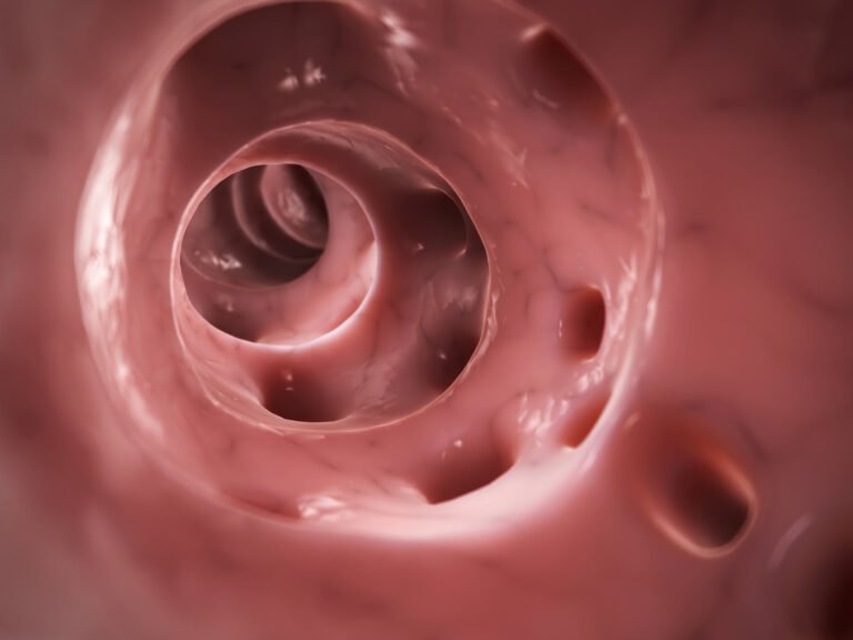 Qué es la diverticulitis
